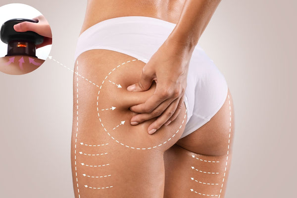 une photo qui montre un corps d'une femme avec la ventouse anti cellulite, cette photo accompagne l'article Comment utiliser la ventouse à cellulite ?